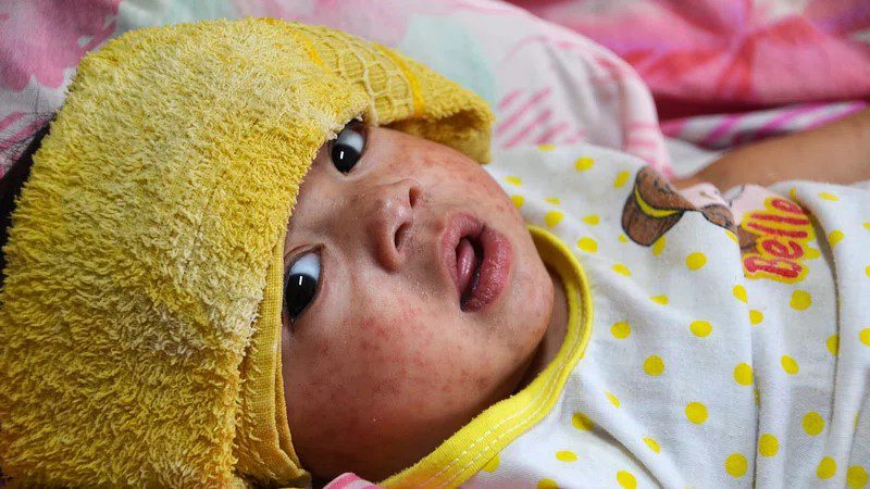 Measles outbreaks across Europe highlight concerning lag in vaccinations