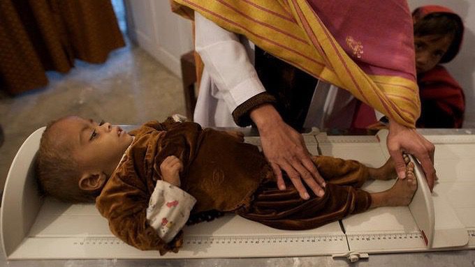 Pakistan child malnutrition
