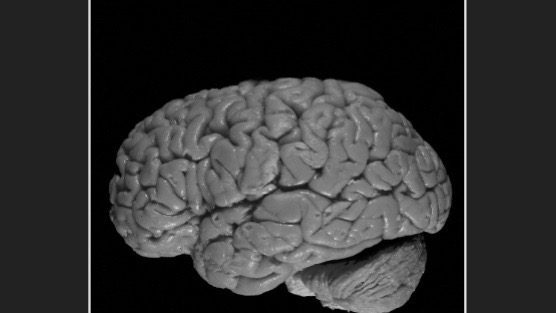 Alzheimer's disease