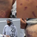 Bruises on the backs and limbs of Global Sumud Flotilla activists